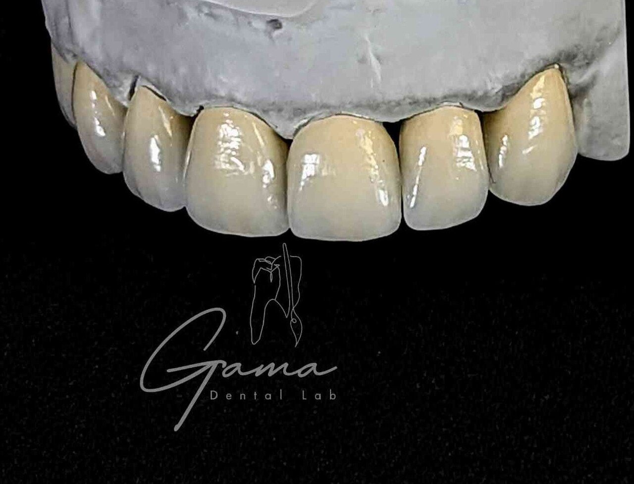 Carillas frontales - Gama Dental Lab