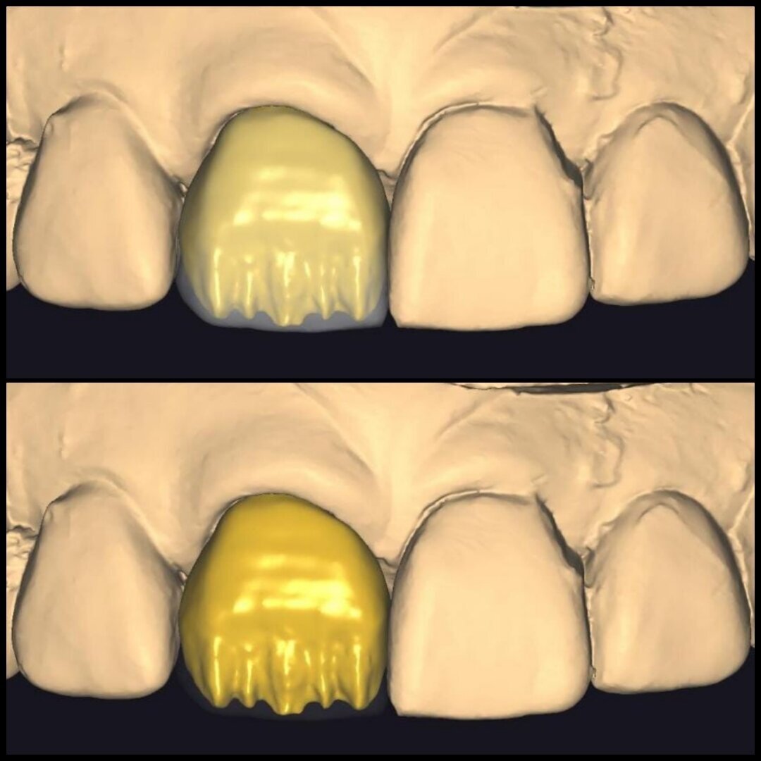 Modelo dental con preparación para carillas - Gama Dental Lab