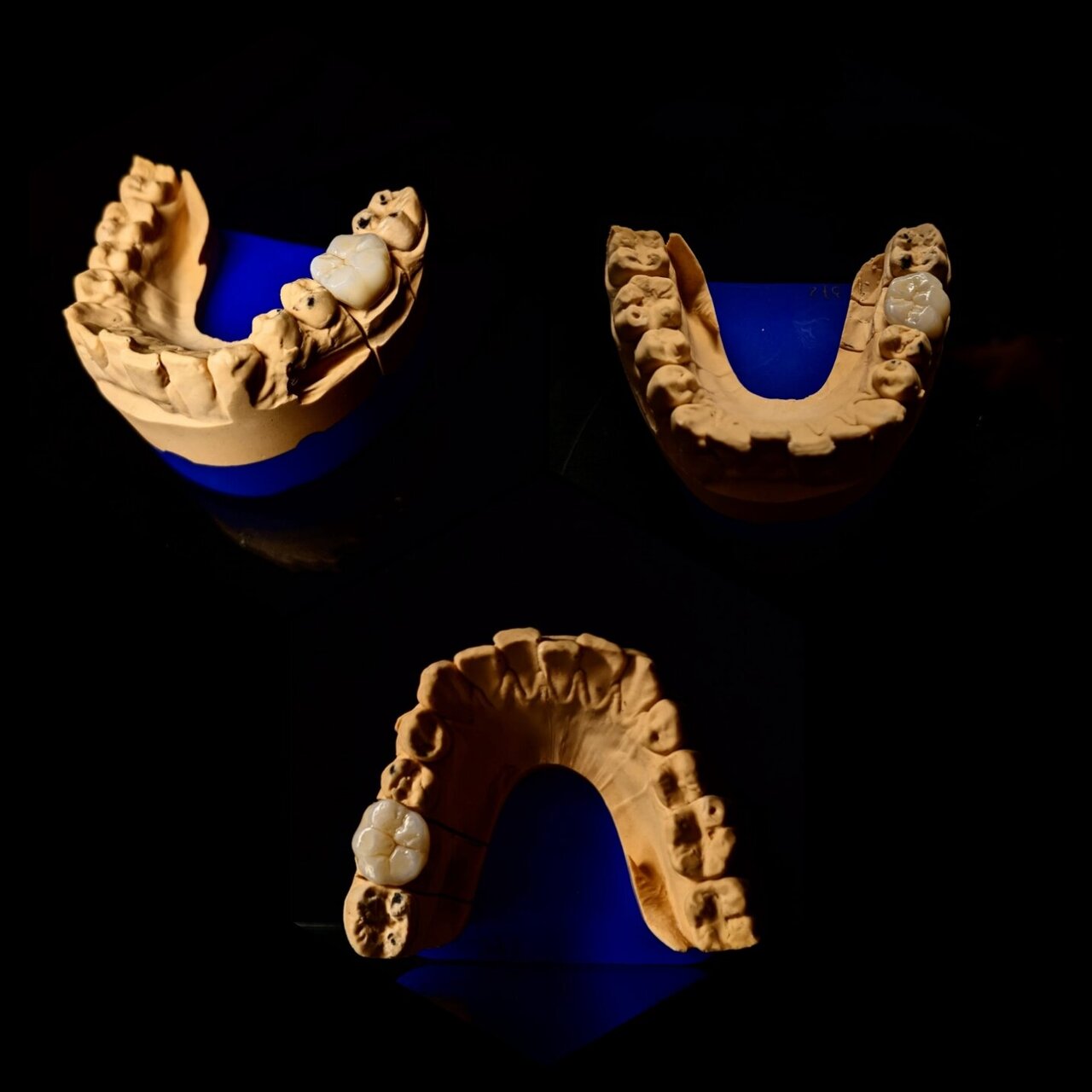 Modelo dental con coronas de zirconia - Gama Dental Lab
