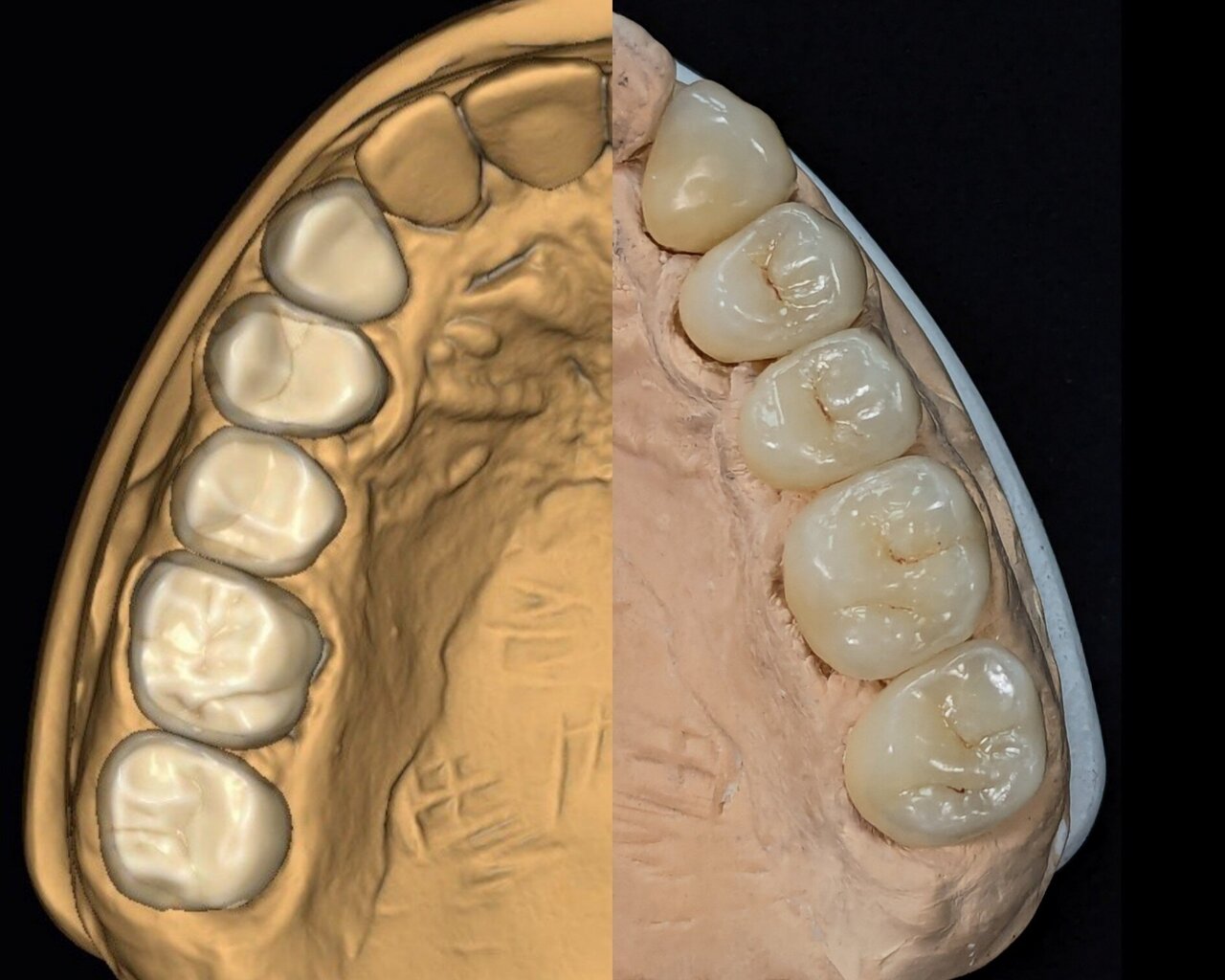 Trabajos en Zirconia - Gama Dental Lab